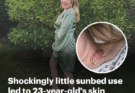 Shockingly little sunbed use that led to 23-year-old’s skin cancer that spread to her lungs and neck